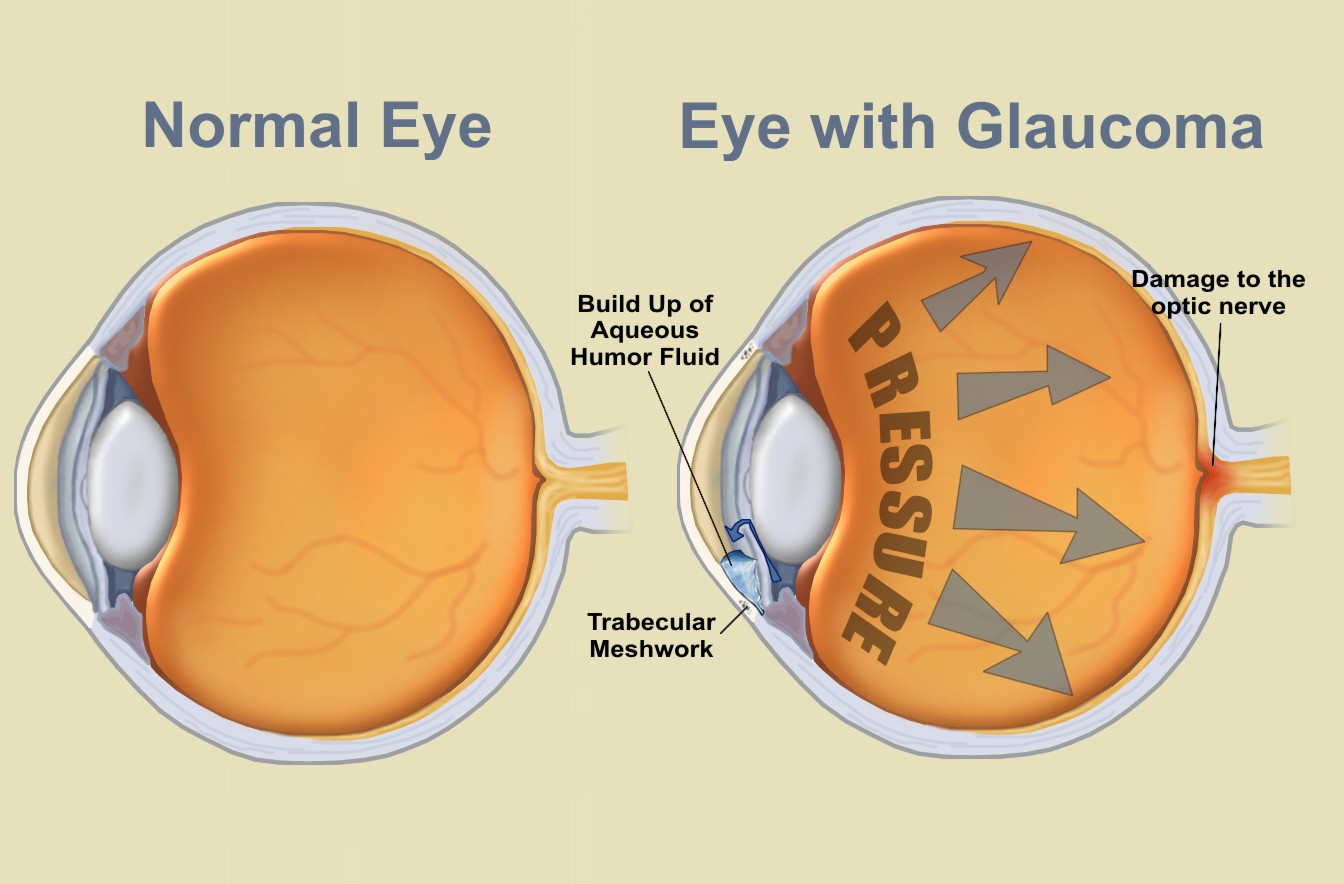 Glaucoma Map
