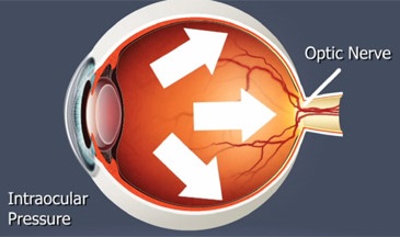 Glaucoma Map